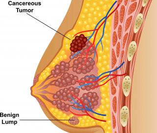 อาการมะเร็งเต้านม